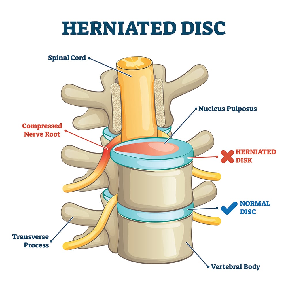 what-is-disc-herniation